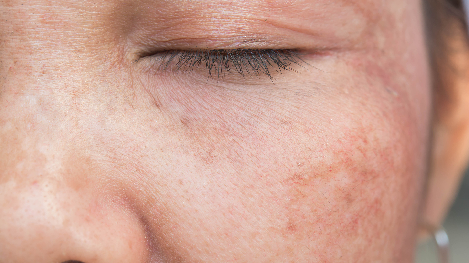 Hyperpigmentation de la peau : symptômes causes & solutions