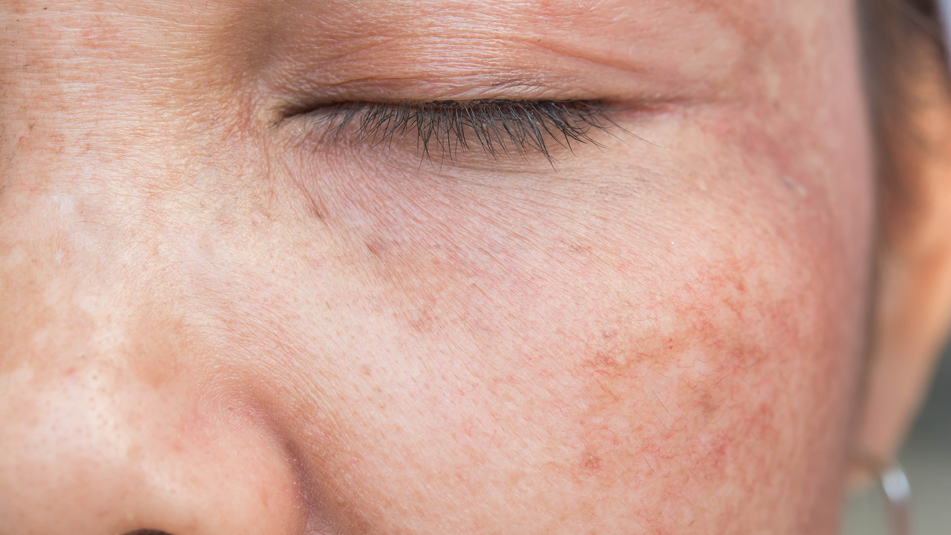 Hyperpigmentation De La Peau Symptomes Causes Solutions Hyperpigmentation De La Peau Symptomes Causes Solutions