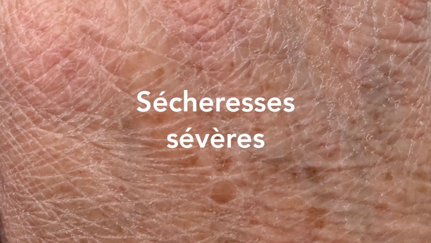 sécheresses sévères mains