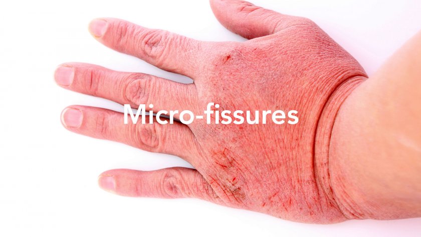 micro-fissures mains