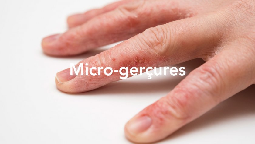 micro-gerçure mains abîmées