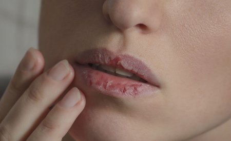 Une femme avec les lèvres sèches