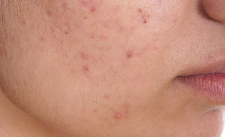 Des boutons d'acné sur un visage
