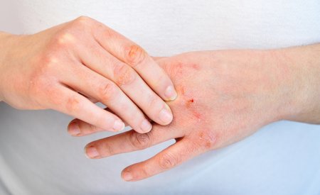 Reconnaître et comprendre l'eczéma de contact