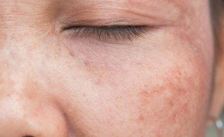 Hyperpigmentation De La Peau Symptomes Causes Solutions Hyperpigmentation De La Peau Symptomes Causes Solutions
