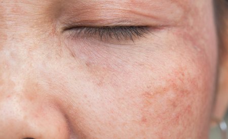 Hyperpigmentation de la peau : symptômes causes & solutions