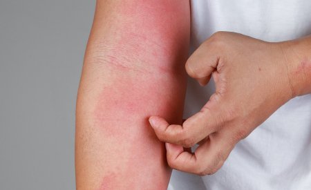 Eczéma ou dermatite atopique : symptômes, causes et traitements