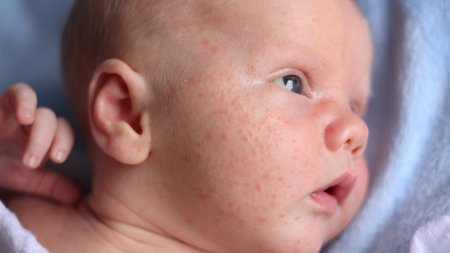 Un bébé avec des boutons