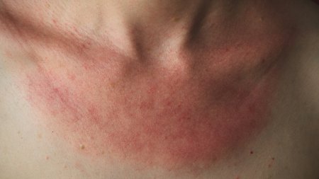 Allergie au soleil, lucite : Comment l'éviter et soulager ?