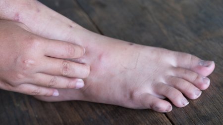Mieux Comprendre Le Pied Du Diabetique Pour Mieux Vivre Avec