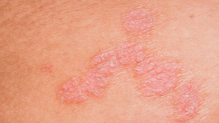 Une photo de psoriasis sur le visage