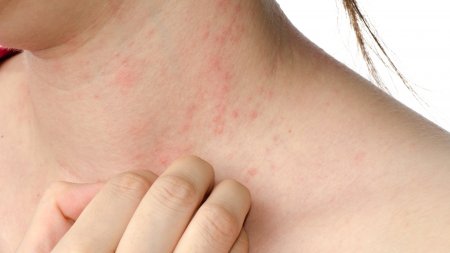 Reconnaître et comprendre l'eczéma de contact