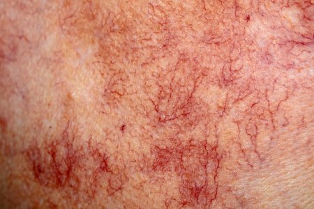 La couperose au visage : quel traitement pour la rosacée ?