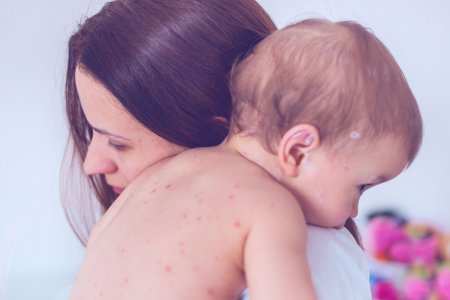Bébé atteint de varicelle nécessitant un soin réparateur