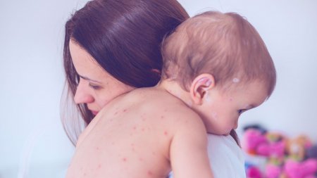 Bébé atteint de varicelle nécessitant un soin réparateur