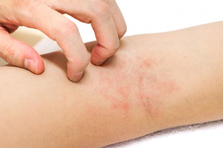 Eczéma ou dermatite atopique : symptômes, causes et traitements