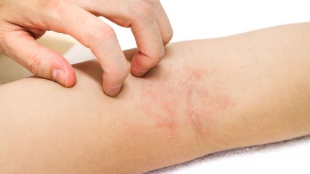 Eczéma ou dermatite atopique : symptômes, causes et traitements