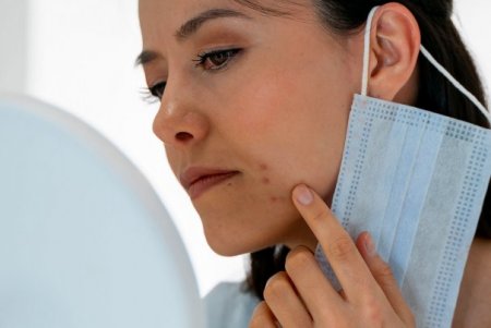 Femme présentant de l'acné en portant son masque