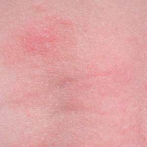 Peau Atopique De Bebe Eczema Comment Traiter La Peau Peau Atopique De Bebe Eczema Comment Traiter La Peau