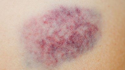Damaged skin - Bruises - Knocks - Bumps