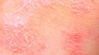 Prendre Soin De La Peau Sensible De Bebe Peau Seche A Atopique Prendre Soin De La Peau Sensible De Bebe Peau Seche A Atopique