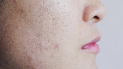 L’hyperpigmentation post-inflammatoire