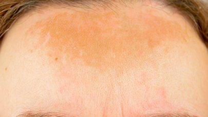 Hyperpigmentation de la peau : symptômes causes & solutions