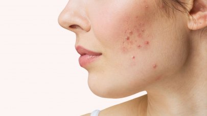 acné visage acné visage