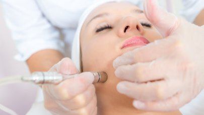 peeling dermabrasion