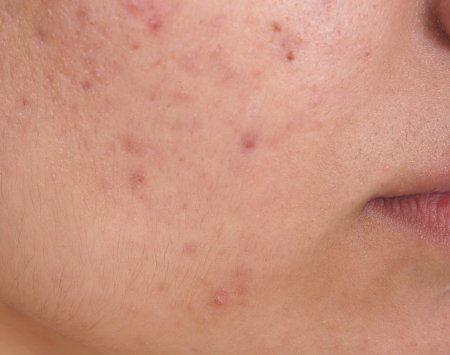 Bioderma - Acne Oily Skin