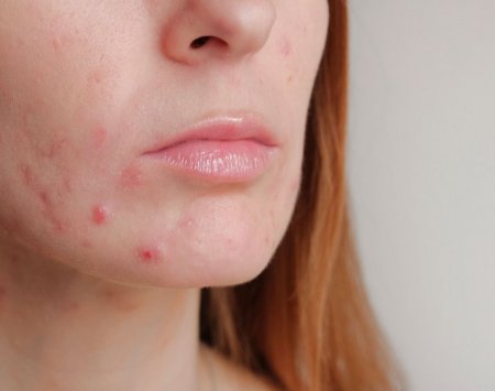 Maskne Masque Acne Reconnaitre Traiter Les Boutons Maskne Masque Acne Reconnaitre Traiter Les Boutons