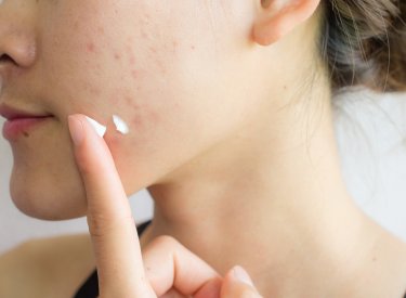 Application d'une crème contre l'acné