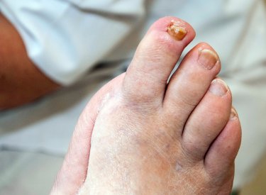 Mieux Comprendre Le Pied Du Diabetique Pour Mieux Vivre Avec