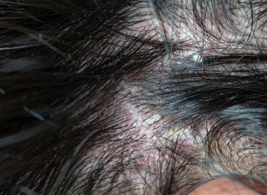 Une dermite séborrhéique au niveau des cheveux