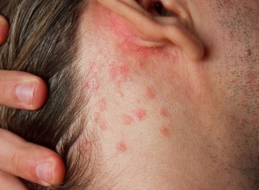 Dermite Seborrheique Cause Symptome Traitement Bioderma Dermite Seborrheique Cause Symptome Traitement Bioderma