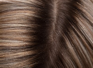 Pellicules Comment Eviter Les Squames Ou Psoriasis Du Cuir Chevelu Pellicules Comment Eviter Les Squames Ou Psoriasis Du Cuir Chevelu