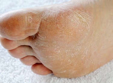 Mieux Comprendre Le Pied Du Diabetique Pour Mieux Vivre Avec