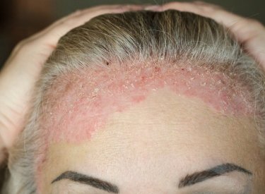 Psoriasis du cuir chevelu