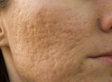 cicatrices d'acné : les traitements pour s'en débarrasser ...