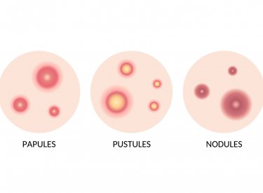 Traitement contre l'acné : faisons le point | BIODERMA France