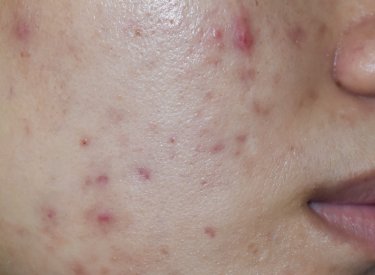pustules pustules