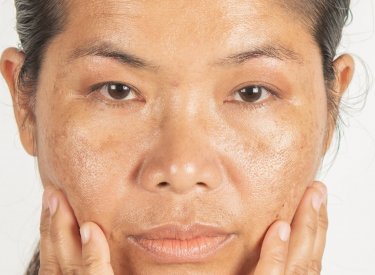 visage melasma femme.jpeg