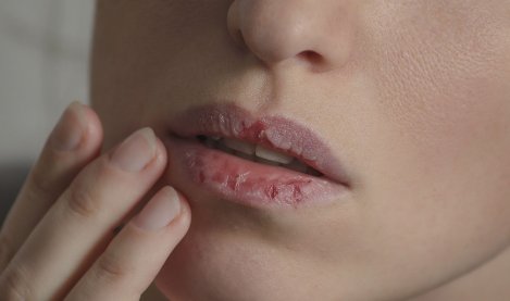Une femme avec les lèvres sèches