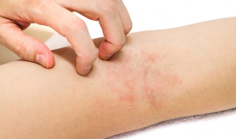 Eczéma ou dermatite atopique : symptômes, causes et traitements