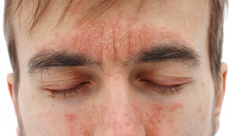Dermite Seborrheique Cause Symptome Traitement Bioderma Dermite Seborrheique Cause Symptome Traitement Bioderma
