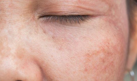 Tâches sur la peau : tâches brunes & problèmes de pigmentation