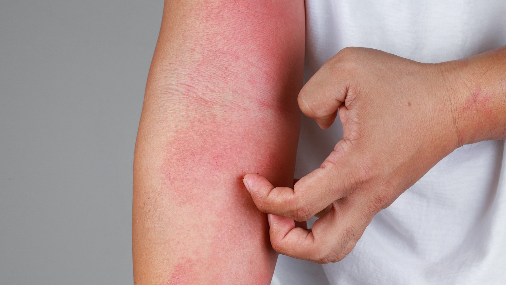 Eczéma : le contact avec l'allergène doit être évité - Pourquoi